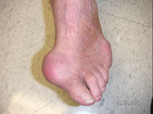 gout bottom of foot hot chiks eating pussy